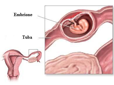 La gravidanza extrauterina: cause e sintomi