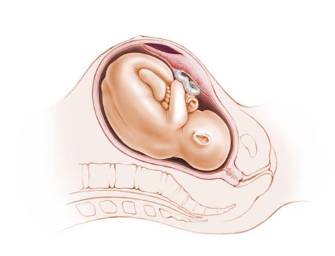 Abruptio placentae ovvero il distacco di placenta