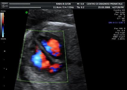 L'ecocardiografia fetale, quando è necessaria