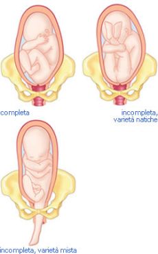 Le posizioni del feto, cefalico o podalico?