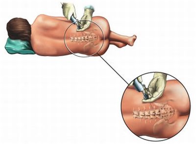 anestesia-spinale