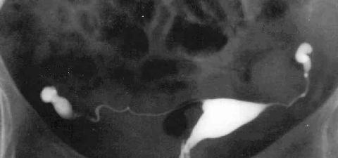 Radiografia dell'utero e delle tube, l'isterosalpingografia