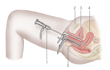 isteroscopia diagnostica