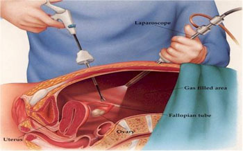 La laparoscopia