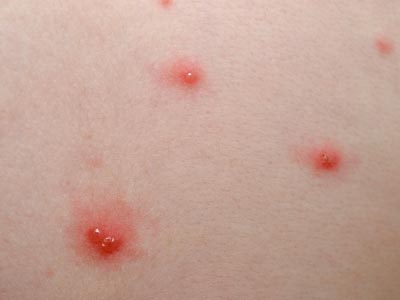 Con la varicella è giusto dare l'antivirale?