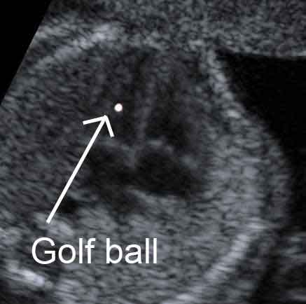 Golf ball o focus iperecogeno del cuore del feto, cos'è?