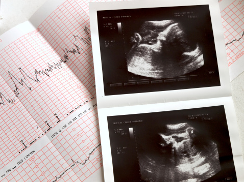 Nuovo esame in gravidanza per diagnosticare la sindrome del QT lungo