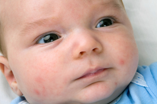 Brufoli sul viso del neonato: cosa potrebbe essere?