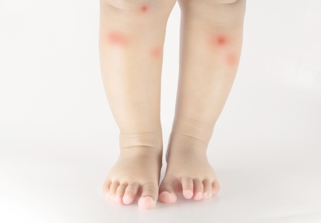 Punture di zanzare, rimedi naturali per bambini e neonati