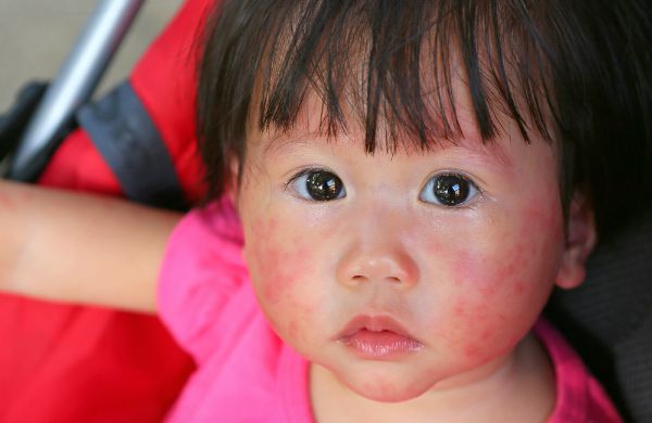 La dermatite atopica colpisce 3 bambini su 10 nel primo anno di vita