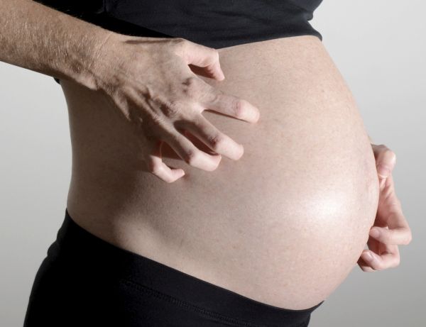 Colestasi intraepatica della gravidanza, sintomi