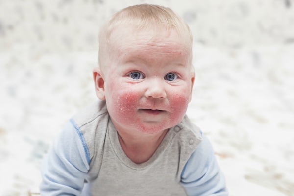 Dermatite atopica nei bambini, grave stress per genitori e piccoli