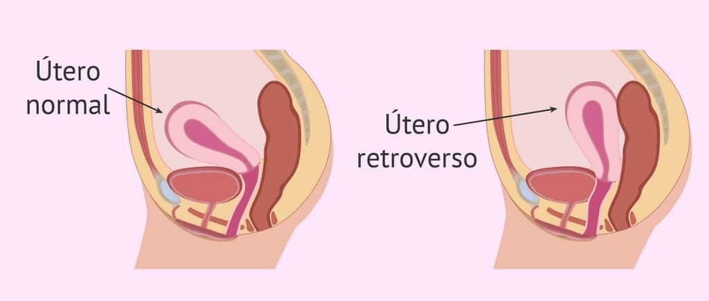 Utero retroverso