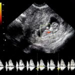 Sentire il battito del feto in gravidanza, quando è possibile?