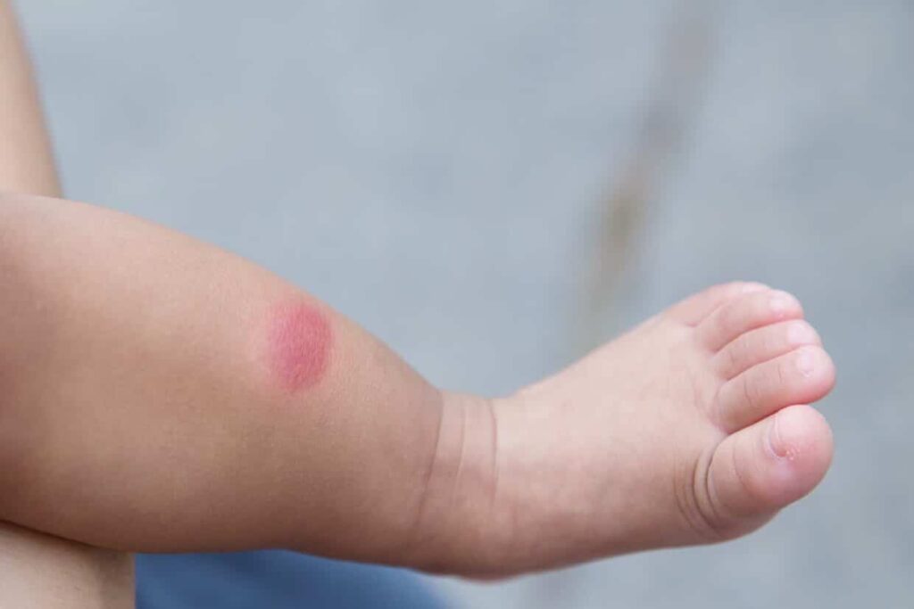 puntura bambino