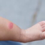 puntura bambino
