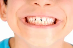 denti rottura