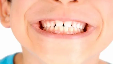 denti rottura