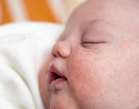eczema neonato